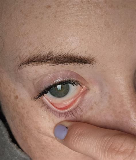 Does My Eyelid Look Normal Ranemic