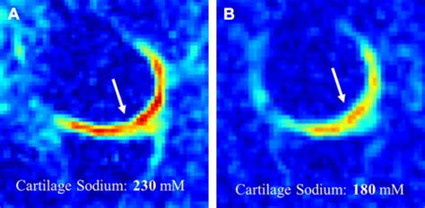 Quantitative Magnetic Resonance Imaging Of The Articular Cartilage Of