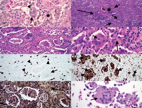 A Note Multinucleated Giant Cell Arrow Within An Airspace The Giant