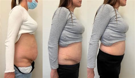 Abdominoplastie Apr S Chirurgie Bariatrique Centre De Chirurgie