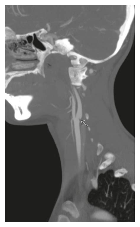 Cta Neck Showing Carotid Web In The Left Internal Carotid Artery