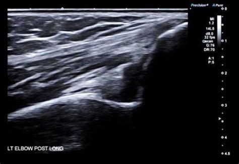 elbow swelling case studies pocusorg