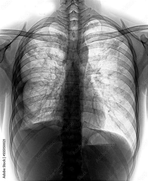 Bronchiectasis . X-ray chest show multiple lung bleb and cyst due to ...