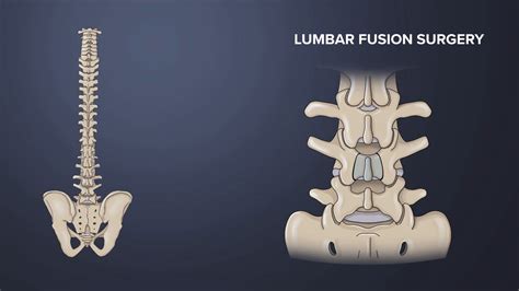 Video: Stages of Bone Healing in Lumbar Spine Fusion Surgery | Spine-health