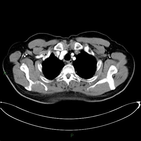 Aortic Arch Origin Of Left Vertebral Artery Radiopaedia