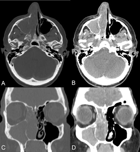 Ct Scan Of Nose And Paranasal Sinuses A Bone Demineralization Of