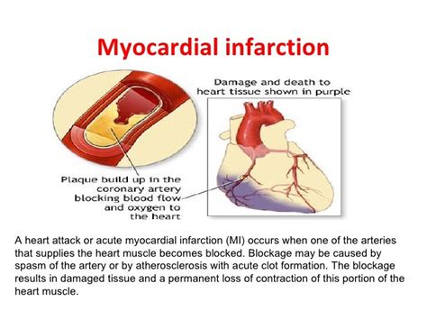 Myocardial infarction