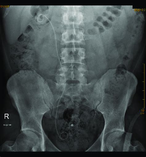 Follow Up Second Postoperative X Ray Showing The Intact Right Ureteral