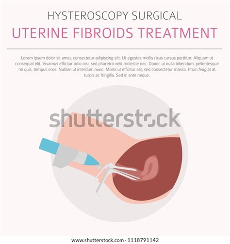 Uterine Fibroids Ginecological Medical Desease Women Stock Vector