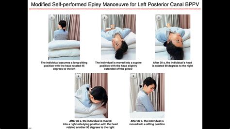 Modified Self Performed Epley Manoeuvre For Left Posterior Canal BPPV