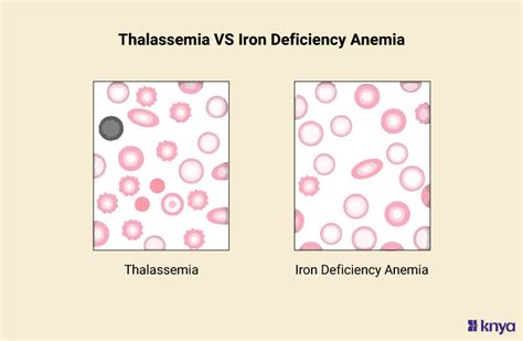 Thalassemia Vs Iron Deficiency Anemia Key Differences Explained Knya