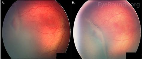 Retinopathy Of Prematurity