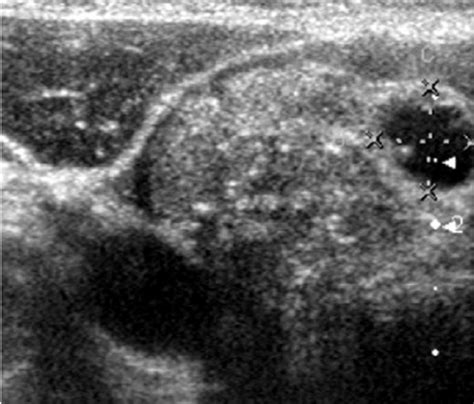 Thyroid Ultrasound Cancer