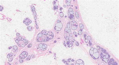 Adenoid Cystic Carcinoma Of The Breast Atlas Of Pathology