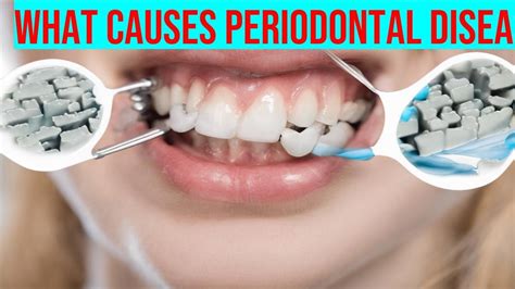 Understanding Periodontal Disease What Are The Symptoms And How Can