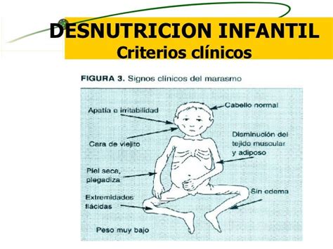 La Desnutrición Infantil