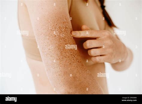 Peeling Skin After Sunburn Dermatology Problems At Woman Hand And