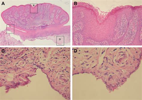 A Mild Keratinizing Tissue Of The Superficial Squamous Epithelium 40