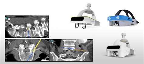 Augmented Reality Spine Surgery｜ar Spine Surgery Surglasses