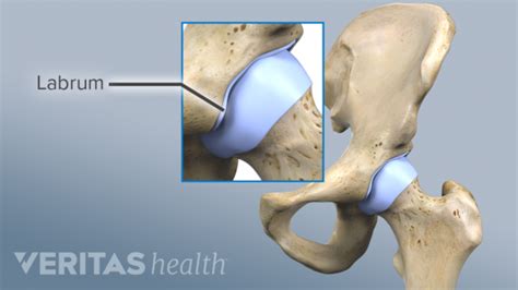 Hip Labral Tear Overview Artofit