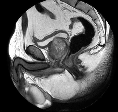 High Resolution Prostate Imaging With Compressed Sense Philips Mr Body Map