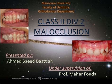 Management Of Class Ii Division 1 Malocclusion