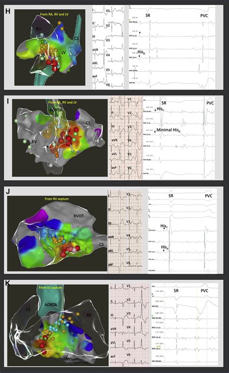 High Resolution Parahisian Mapping And Ablation Using Microelectrode