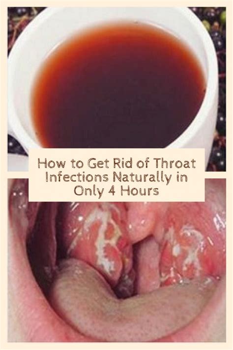 How To Get Rid Of Throat Infections Naturally In Only Hours