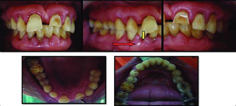 Clinical Examination Revealing Gingival Enlargement In Areas Where