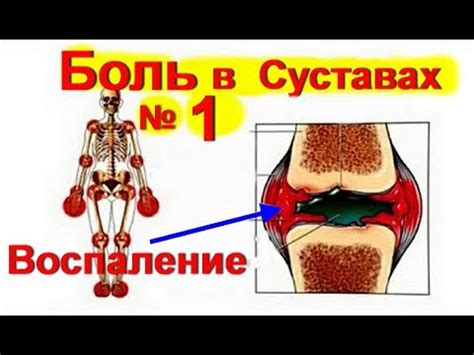 Болят суставы что делать? Лечение суставов № 1 Артрит. Артроз - YouTube