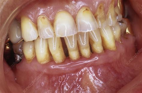 Receding Gums In Gum Disease Stock Image C023 5433 Science Photo