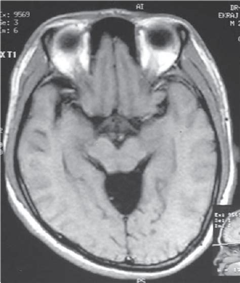 Mri In T1 Sagittal Section Showing A Large Trigeminal Cistern Arachnoid