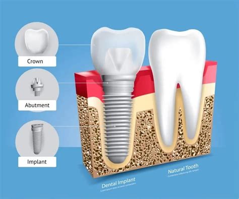 Tooth Abutment