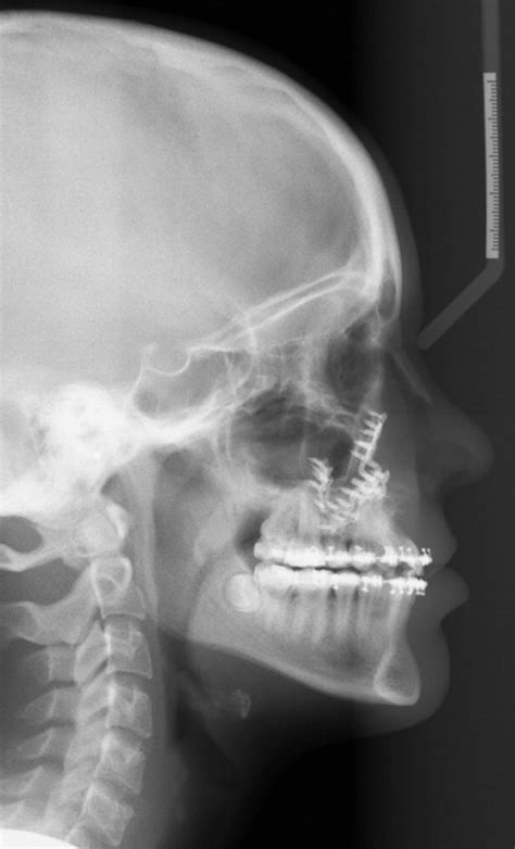 Radiology Of Cleft Lip And Palate Imaging For The Prenatal Period And