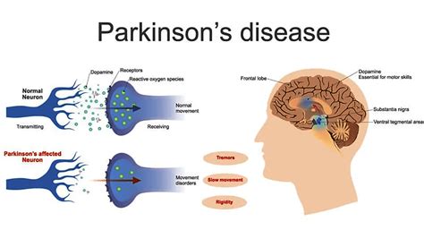 Parkinsons Disease Dopamine