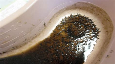 Coffee Ground Vomitus Causes Symptoms And Treatment