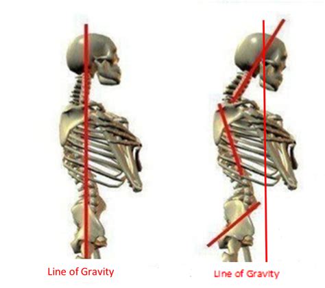 Forward Head Posture Muscles Involved