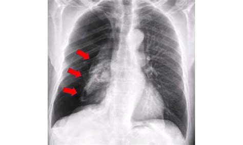 Ai System More Accurately Identifies Collapsed Lungs Using Chest X Rays