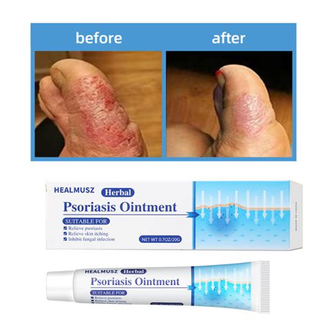 Psoriasis Antibacterial Cream 20g Topical Skin Inhibition Bacteria