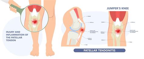 Dr David Samra Sports Medicine Sydney Jumpers Knees