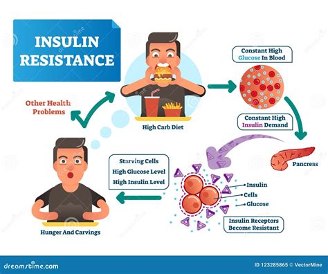 Insulin Resistance Vector Illustration Labeled Scheme With All Cycle