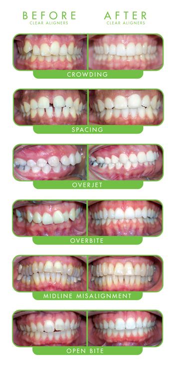 Invisible Braces Before And After