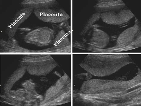 Placenta Membranacea