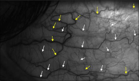 Image Of A Scleral Region Episcleral Vessels Are Marked With Yellow Download Scientific