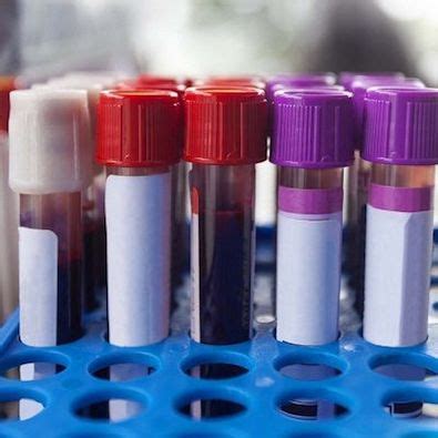 Blood Test Shows Promise In Predicting Presymptomatic Disease