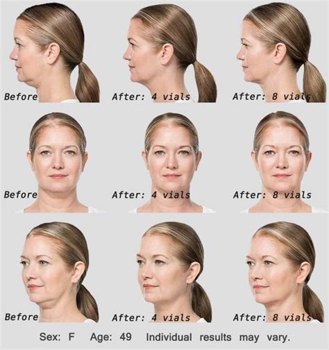 Kybella Cost Prices List For Double Chin Reviews