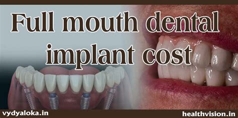 Dental Implants Cost