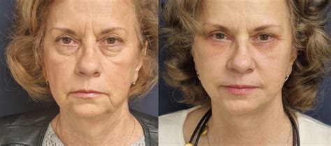 Inainte Si Dupa Before And After Facelift Si Necklift