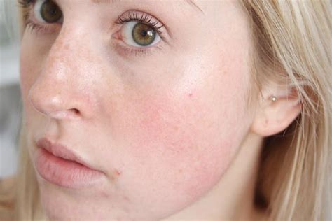 12 Easy And Effective Remedies To Get Rid Of Redness Of Face Naturally