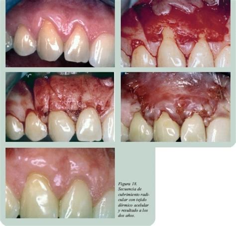 Técnicas de cirugía mucogingival para el cubrimiento radicular